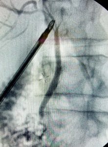 X-ray of the bile ducts taken during an operation
