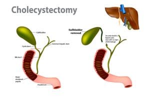 Cholecystectomy gallbladder removal illustration