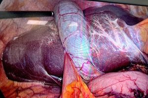 Duodenum and gallbladder shown attached to the liver