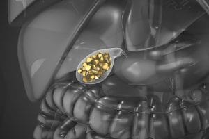 Gallstones illustration